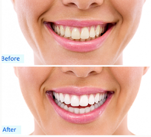 Whitening